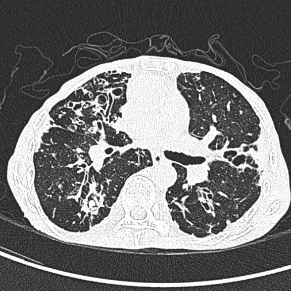 Aspergilloma- with Monod sign (Radiopaedia 44737-48532 Axial lung window 127).jpg