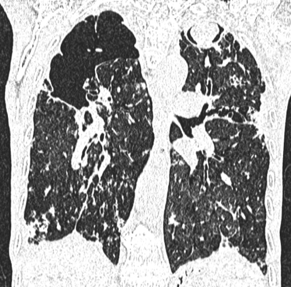 Aspergilloma- with Monod sign (Radiopaedia 44737-48532 Coronal lung window 286).jpg