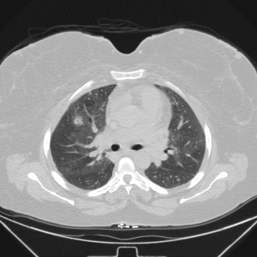Aspergilloma (Radiopaedia 39611-41932 Axial lung window 52).jpg