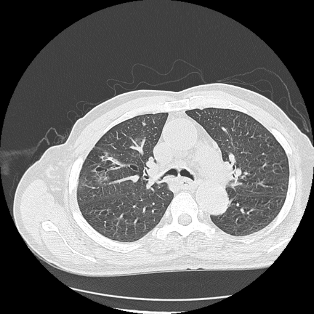 Aspergilloma (Radiopaedia 44592-48327 Axial lung window 30).jpg