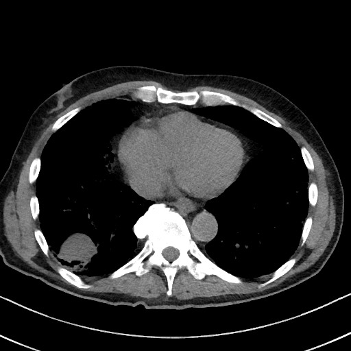 Aspergilloma on background pulmonary fibrosis (Radiopaedia 60942-68757 Axial non-contrast 40).jpg
