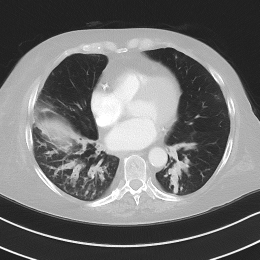 Aspiration bronchiolitis (Radiopaedia 53464-59463 Axial lung window 37).png