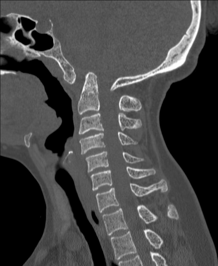 Atlanto-occipital assimilation with basilar invagination (Radiopaedia 70122-80188 Sagittal bone window 59).jpg