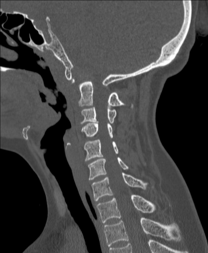 Atlanto-occipital assimilation with basilar invagination (Radiopaedia 70122-80188 Sagittal bone window 81).jpg