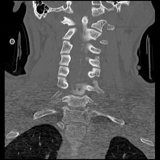 Atlanto-occipital dissociation injury (Radiopaedia 29274-29698 Coronal bone window 24).png