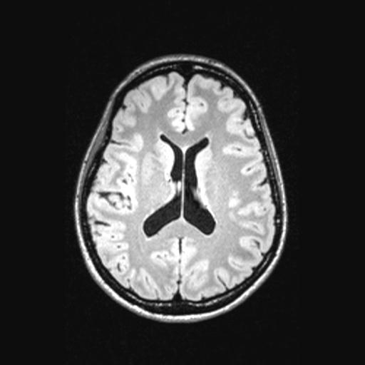 Atretic encephalocoele with inferior vermis hypoplasia (Radiopaedia 30443-31108 Axial 94).jpg