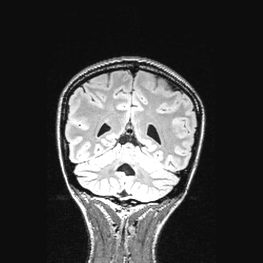 Atretic encephalocoele with inferior vermis hypoplasia (Radiopaedia 30443-31108 Coronal FLAIR 59).jpg