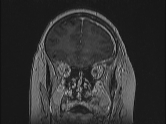 Atypical meningioma (Radiopaedia 62985-71406 Coronal T1 C+ 26).jpg