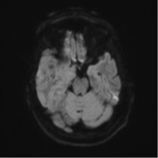 Atypical meningioma (WHO Grade II) (Radiopaedia 54742-60979 Axial DWI 38).png