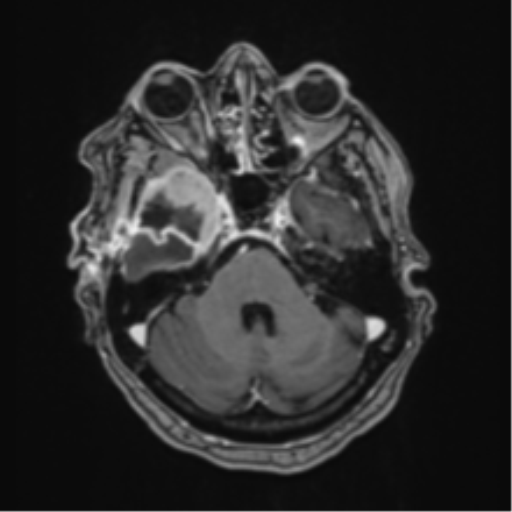 Atypical meningioma (WHO Grade II) (Radiopaedia 54742-60981 Axial T1 C+ 18).png