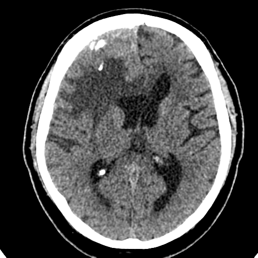 File:Atypical meningioma (WHO grade II) with brain invasion (Radiopaedia 57767-64728 Axial non-contrast 23).png