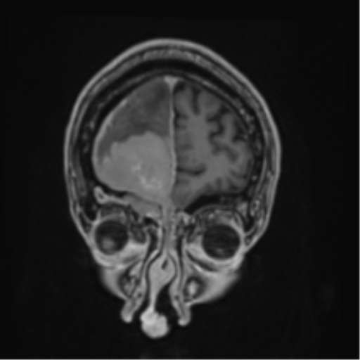 File:Atypical meningioma (WHO grade II) with brain invasion (Radiopaedia 57767-64729 Coronal T1 C+ 8).png