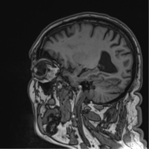Atypical meningioma (WHO grade II) with brain invasion (Radiopaedia 57767-64729 Sagittal T1 26).png