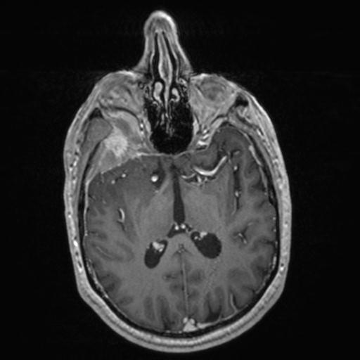Atypical meningioma (grade II) - en plaque (Radiopaedia 29633-30147 Axial T1 C+ 93).jpg