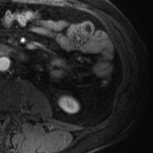 File:Atypical renal cyst on MRI (Radiopaedia 17349-17046 C 29).jpg