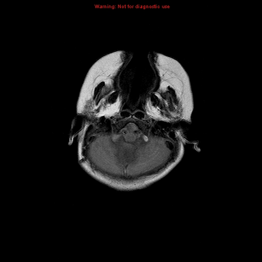 File:Atypical teratoid rhabdoid tumor (Radiopaedia 10712-11183 Axial FLAIR 16).jpg