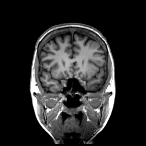 Autoimmune limbic encephalitis (Radiopaedia 30363-31005 Coronal T1 40).jpg