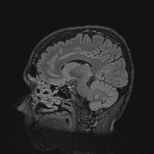 Autoimmune limbic encephalitis (Radiopaedia 30363-31005 Sagittal FLAIR 91).jpg