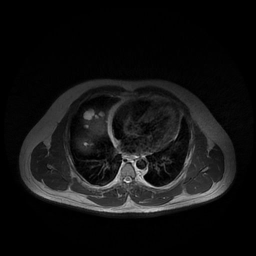 File:Autosomal dominant polycystic kidney disease (Radiopaedia 50259-55611 Axial T2 1).jpg