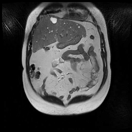 File:Autosomal dominant polycystic kidney disease (Radiopaedia 50259-55611 Coronal T2 10).jpg