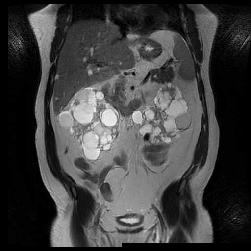 File:Autosomal dominant polycystic kidney disease (Radiopaedia 50259-55611 Coronal T2 18).jpg