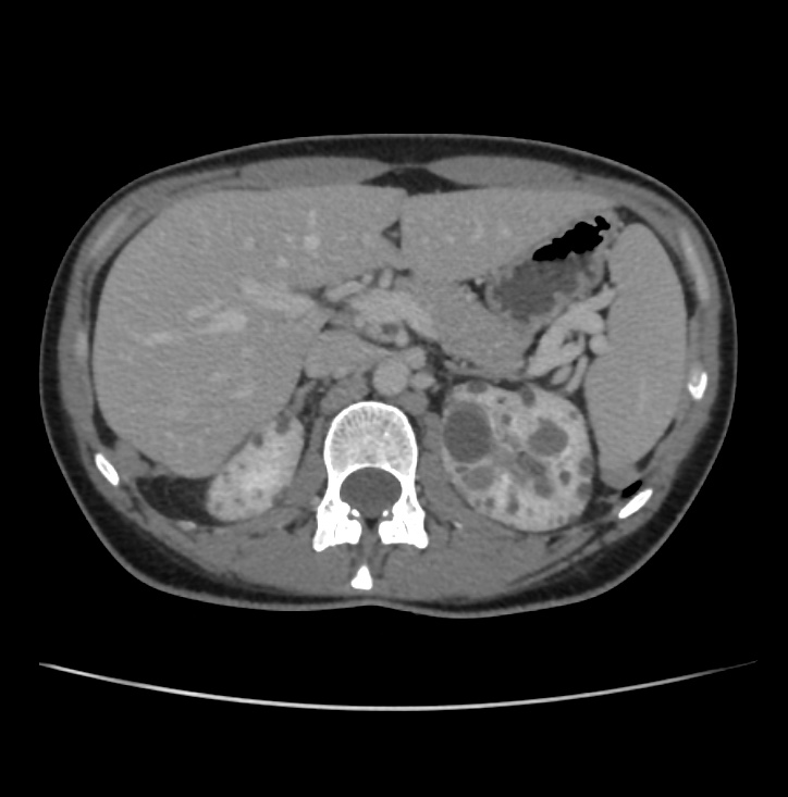 Autosomal dominant polycystic kidney disease - early onset (Radiopaedia 40734-43387 A 17).jpg