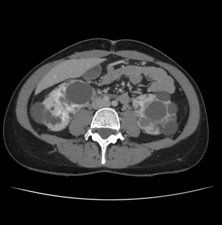 Autosomal dominant polycystic kidney disease - early onset (Radiopaedia 40734-43387 A 48).jpg