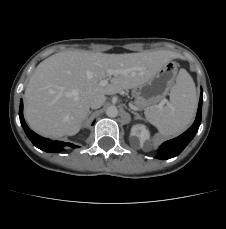 Autosomal dominant polycystic kidney disease - early onset (Radiopaedia 40734-43387 A 8).jpg