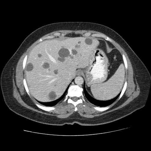 Autosomal dominant polycystic kidney disease with hepatic involvement (Radiopaedia 32693-33662 B 12).jpg
