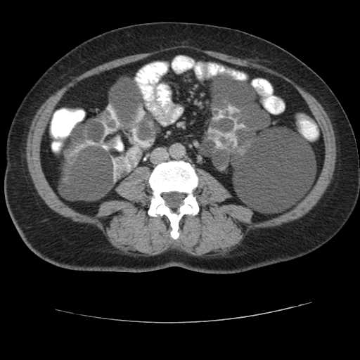 Autosomal dominant polycystic kidney disease with hepatic involvement (Radiopaedia 32693-33662 C 46).jpg