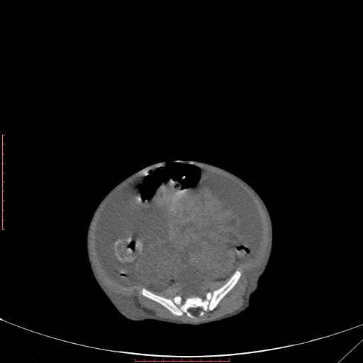 Autosomal recessive polycystic kidney disease associated with Caroli disease (Radiopaedia 61932-69984 Axial non-contrast 286).jpg