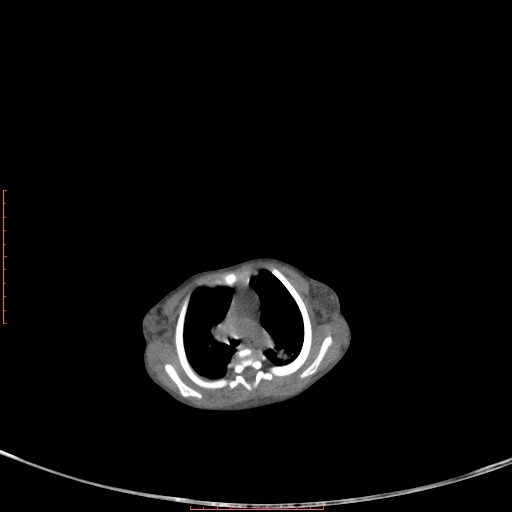 Autosomal recessive polycystic kidney disease associated with Caroli disease (Radiopaedia 61932-69984 Axial non-contrast 31).jpg