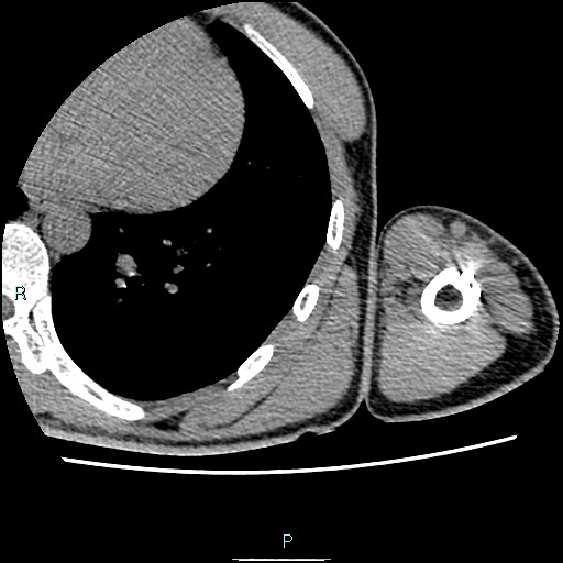 File:Avascular necrosis after fracture dislocations of the proximal humerus (Radiopaedia 88078-104653 D 92).jpg