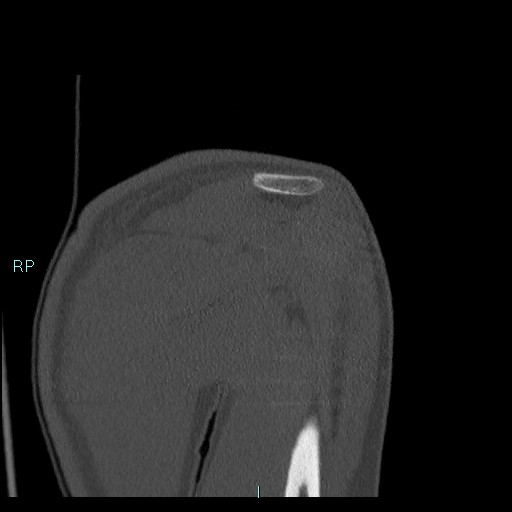 Avascular necrosis after fracture dislocations of the proximal humerus (Radiopaedia 88078-104655 Coronal bone window 50).jpg