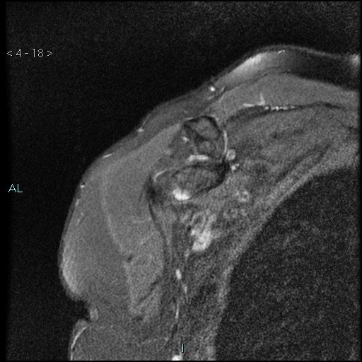 File:Avascular necrosis of the shoulder - Cruess stage I (Radiopaedia 77674-89886 Coronal PD fat sat 18).jpg