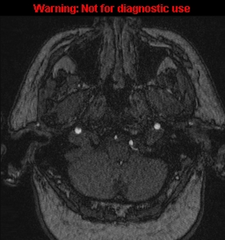 Azygos anterior cerebral artery (Radiopaedia 59325-66677 Axial MRA 11).jpg
