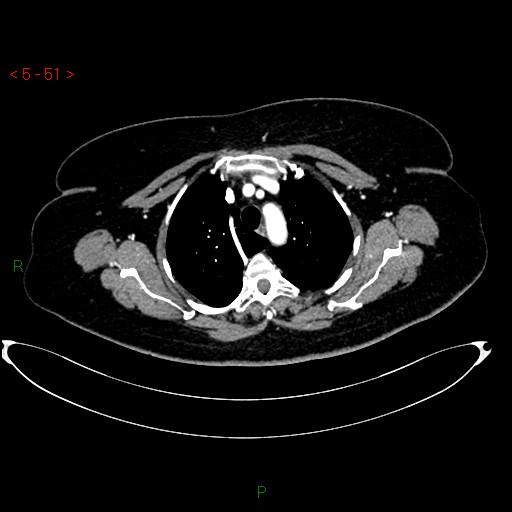 File:Azygos fissure and lobe (Radiopaedia 47620-52278 A 37).jpg