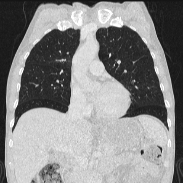 Azygos lobe (Radiopaedia 38259-40275 Coronal lung window 32).jpg