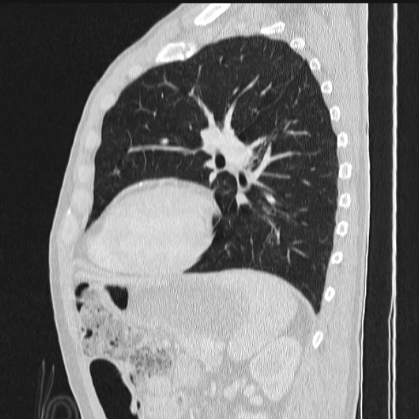Azygos lobe (Radiopaedia 38259-40275 lung window 66).jpg