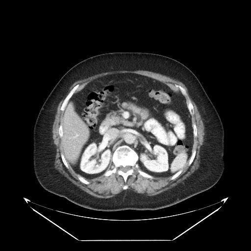 File:B-cell lymphoma of the mesentery (Radiopaedia 65711-74827 Axial 39).jpg