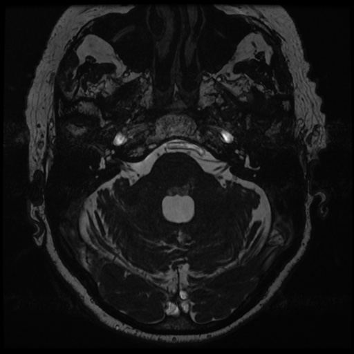 File:Balo concentric sclerosis (Radiopaedia 53875-59982 Axial T2 FIESTA 33).jpg