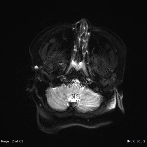 Balo concentric sclerosis (Radiopaedia 61637-69636 Axial DWI 2).jpg