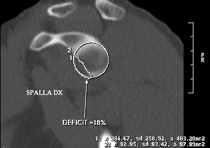 File:Bankart lesion with glenoid bone defect - CT assessment with PICO method (Radiopaedia 42855-93901 Right sagittal 1).png