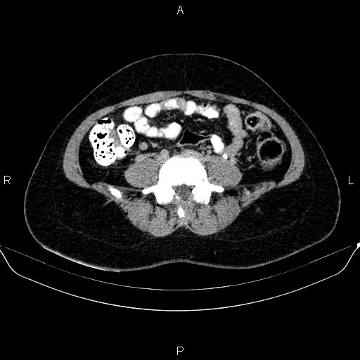 File:Bartholin gland cyst (Radiopaedia 62635-70930 C 1).jpg