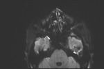 File:Basal cell carcinoma - nasal region (Radiopaedia 70292-80365 Axial DWI 25).jpg