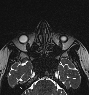 Basal cell carcinoma - nasal region (Radiopaedia 70292-80365 Axial Gradient Echo 56).jpg