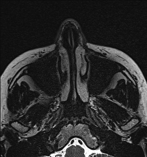 Basal cell carcinoma - nasal region (Radiopaedia 70292-80365 Axial Gradient Echo 7).jpg