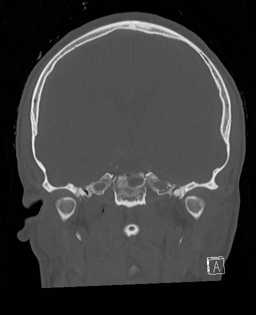 Base of skull fracture with bilateral Le Fort fractures (Radiopaedia 47094-51638 Coronal bone window 49).jpg