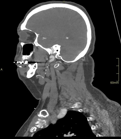 File:Basilar artery aneurysm (Radiopaedia 56261-62932 C 7).jpg