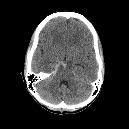File:Basilar artery perforator aneurysm (Radiopaedia 82455-96597 Axial non-contrast 13).jpg